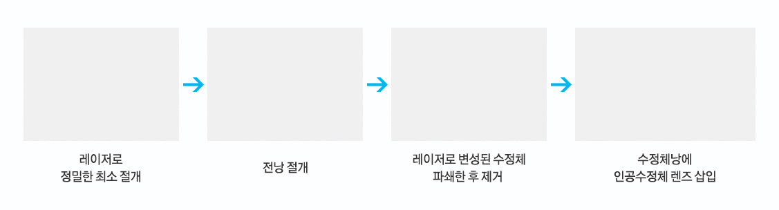 최소 절개 > 전낭 절개 > 레이저로 변셩된 수정체 파쇄한 후 제거 > 수정체낭에 인공수정체 렌즈 삽입