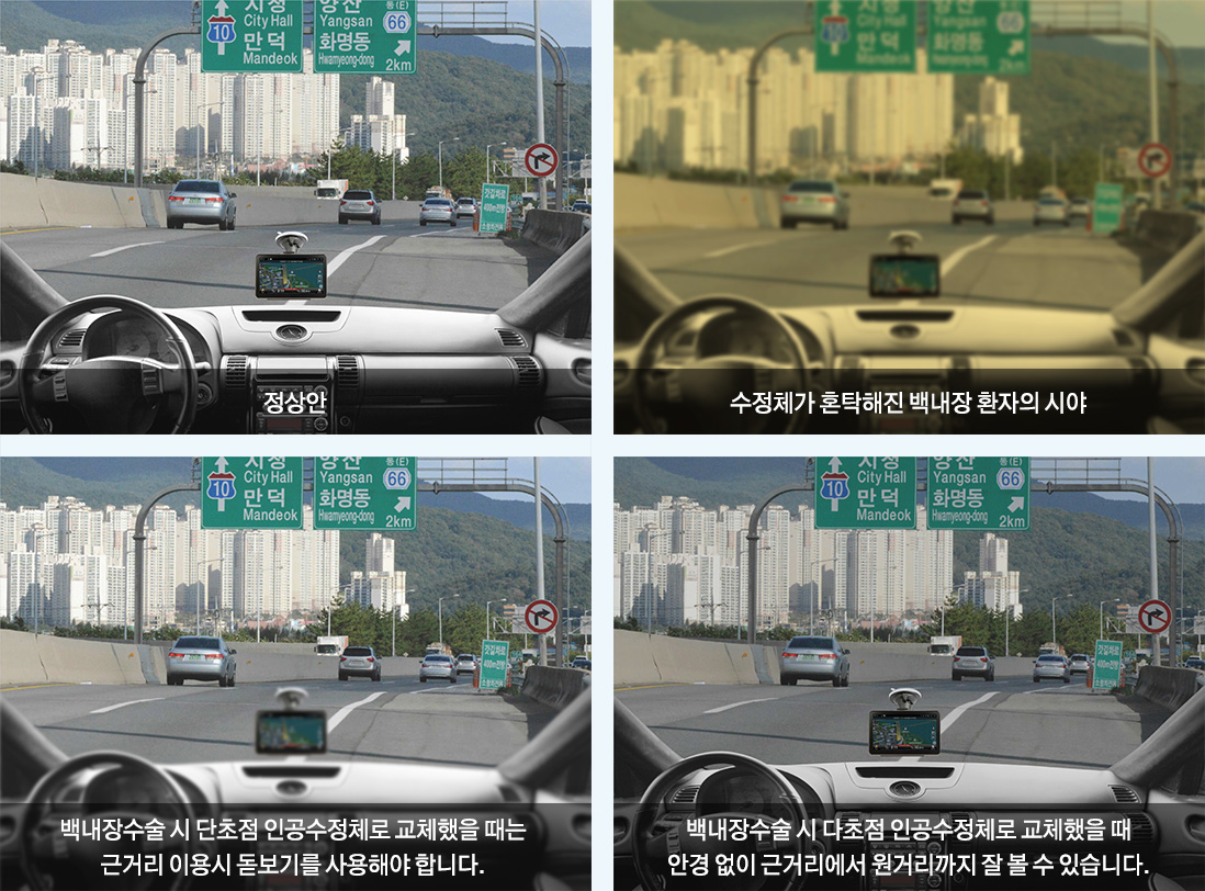 정상안 / 정체가 혼탁해진 백내장 환자의 시야 / 백내장수술 시 단초점 인공수정체로 교체했을 때는 근거리 이용시 돋보기를 사용해야 합니다. / 백내장 수술 시 다초점 인공수정체로 교체했을 때 안경 없이 근거리에서 원거리까지 잘 볼 수 있습니다.