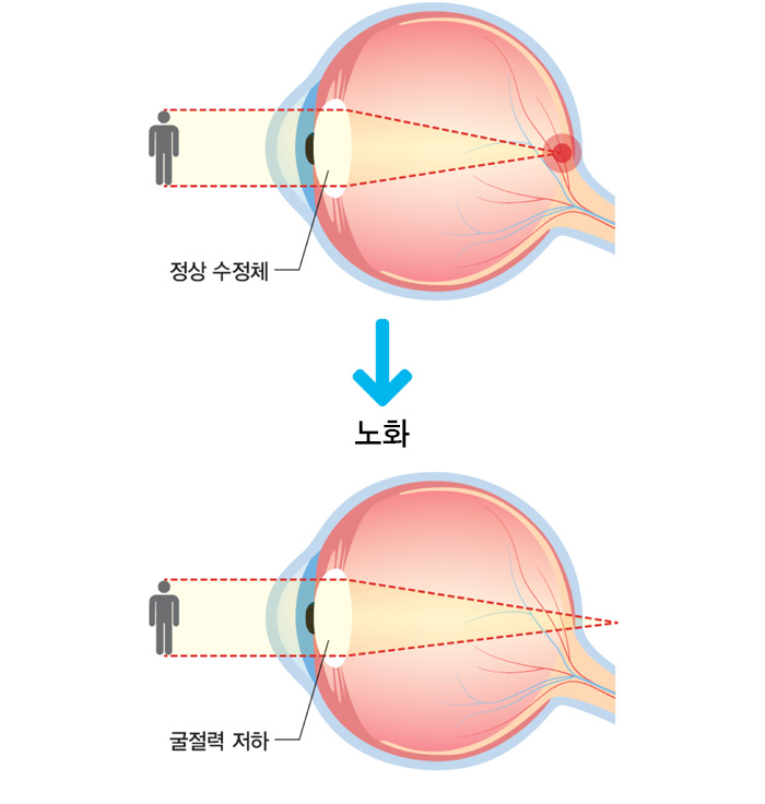 정상 수정체 노화 후 굴절력 저하