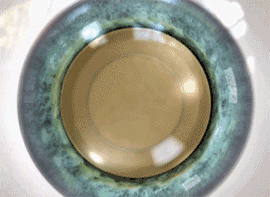 레이저로 변셩된 수정체 파쇄한 후 제거